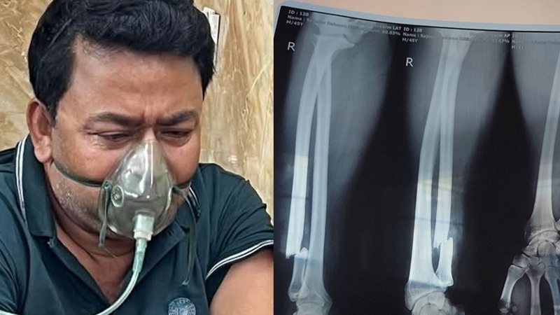 সাংবাদিকের দুই হাত ভেঙে দিল বিএনপির কর্মীরা