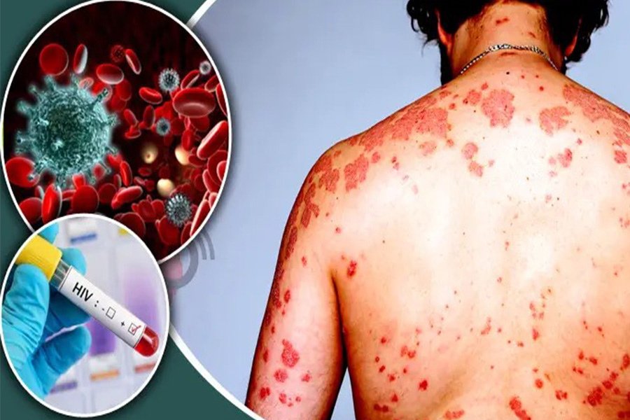 রাজশাহীতে বাড়ছে এইডস রোগীর সংখ্যা