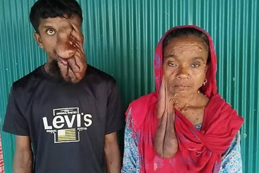 বিরল টিউমারে মুখ ঢেকেছে মা-ছেলের, অসহায় পরিবার